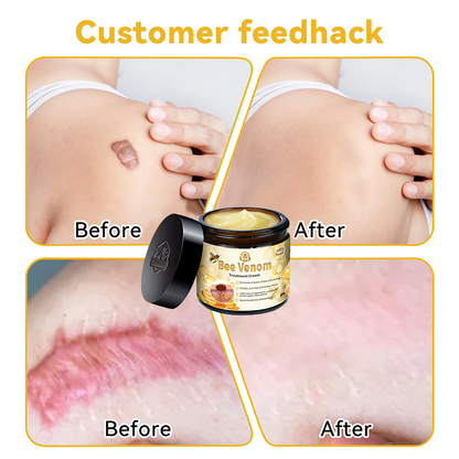 Turonu™ Bee Venom Skin Treatment Cream📦（𝐴𝐴𝐷 𝑅𝑒𝑐𝑜𝑚𝑚𝑒𝑛𝑑𝑒𝑑） (🔥𝑳𝒂𝒔𝒕 𝒅𝒂𝒚 𝒑𝒓𝒐𝒎𝒐𝒕𝒊𝒐𝒏 80% 𝒐𝒇𝒇)